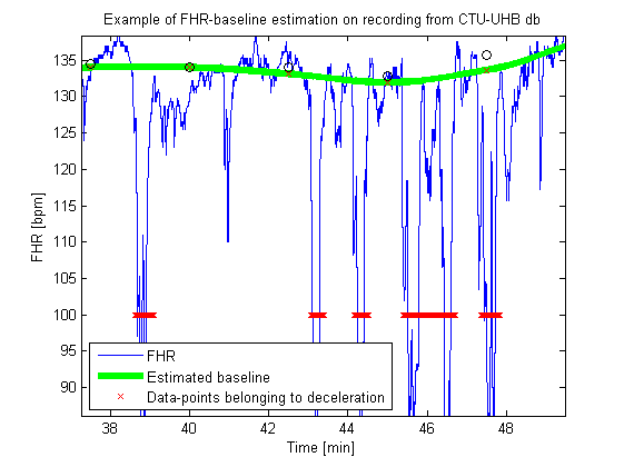 detected deceleration of FHR signal